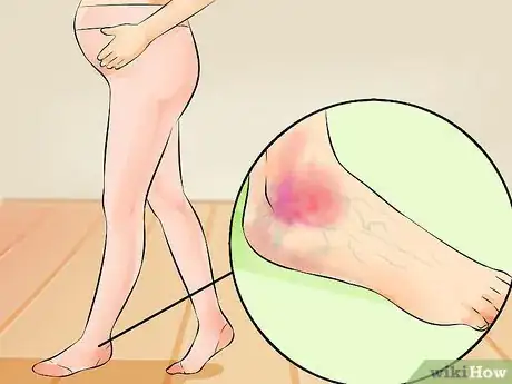 Imagen titulada Put on Compression Stockings Step 22