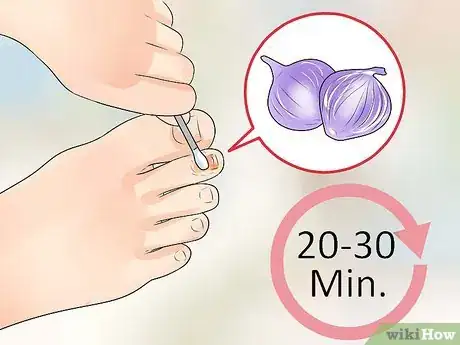 Imagen titulada Get Rid of Foot Fungus at Home Step 4