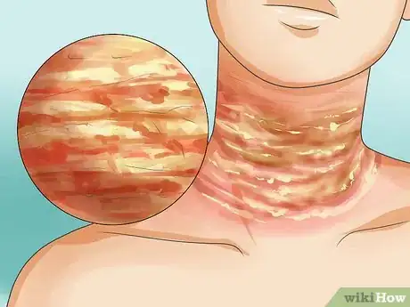 Imagen titulada Recognize Scabies Rash Step 5