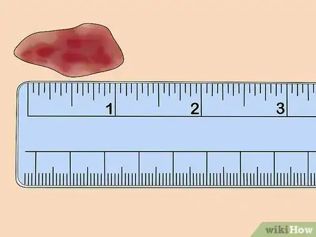 Imagen titulada Measure Wounds Step 2