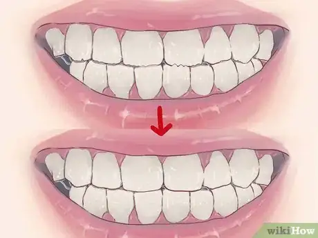 Imagen titulada Stop Grinding Teeth at Night Step 14