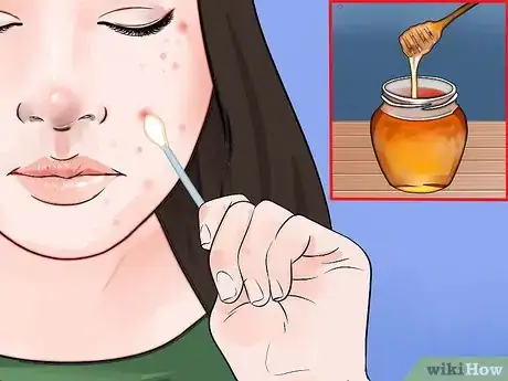 Imagen titulada Remove Ingrown Hair on Your Face Step 5