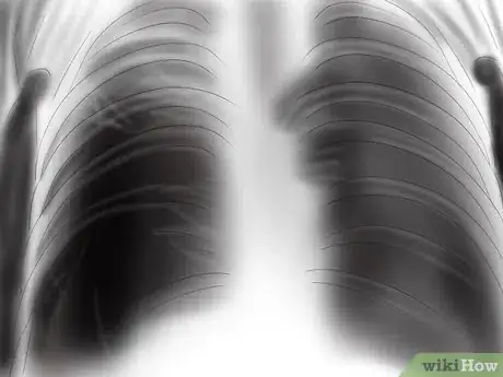 Imagen titulada Recognize the Signs and Symptoms of Tuberculosis Step 13