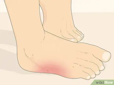 Imagen titulada Know if You Have Neuropathy in Your Feet Step 3