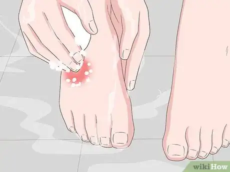 Imagen titulada Reduce Bug Bite Swelling Step 3