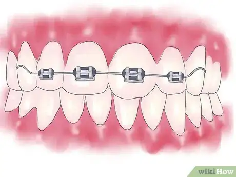 Imagen titulada Fix Crooked Teeth Step 18