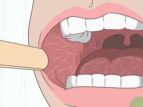 Imagen titulada Treat Mouth Ulcers Naturally Step 16