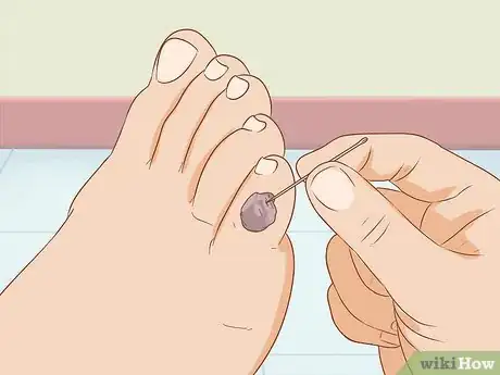 Imagen titulada Treat a Blood Blister Step 10