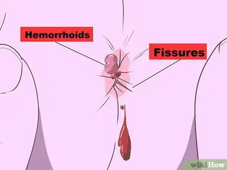 Imagen titulada Stop Rectal Bleeding Step 11