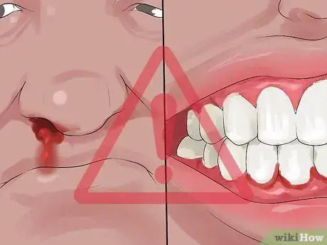 Imagen titulada Diagnose Polycythemia Vera Step 5