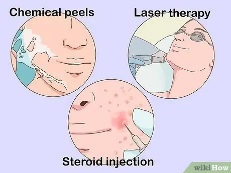 Imagen titulada Treat Nodular Acne Step 5