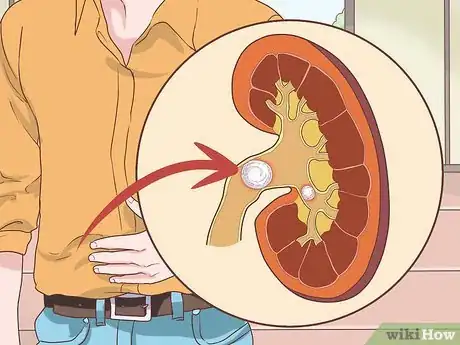 Imagen titulada Know if You Have Kidney Problems Step 1