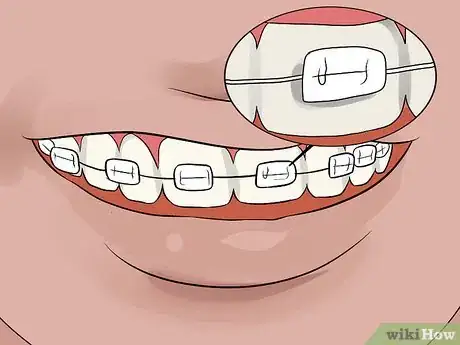 Imagen titulada Whiten Your Teeth when You Have Braces Step 10