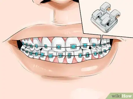 Imagen titulada Connect a Rubber Band to Your Braces Step 2