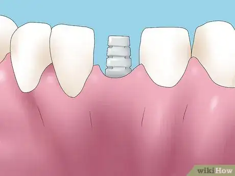 Imagen titulada Reverse Dental Bone Loss Step 1