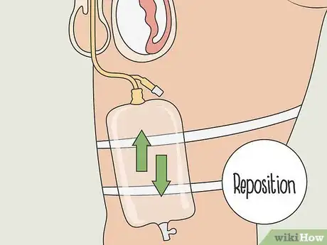 Imagen titulada Unblock a Catheter Step 6