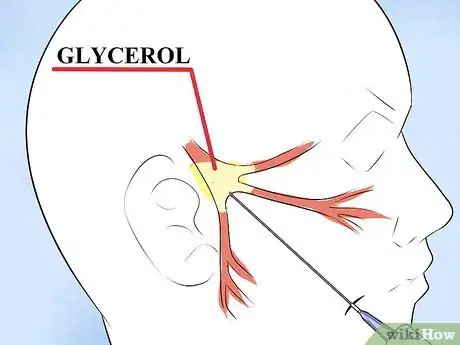 Imagen titulada Alleviate Pain Caused by Trigeminal Neuralgia Step 9