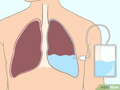 Imagen titulada Ease Pleurisy Pain Step 6