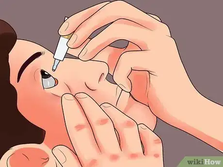 Imagen titulada Use Erythromycin Eye Ointment Step 3