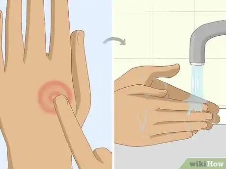 Imagen titulada Get Rid of Ringworm Naturally Step 8