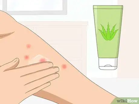 Imagen titulada Heal Mosquito Bites Fast Step 4