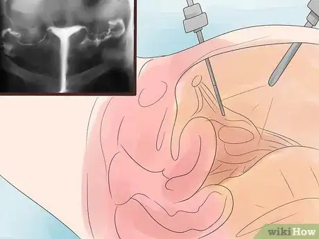 Imagen titulada Treat Blocked Fallopian Tubes Step 5