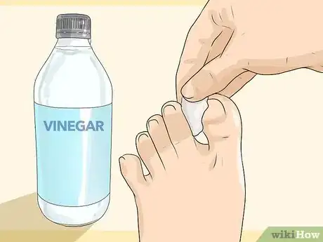 Imagen titulada Get Rid of Calluses Step 10