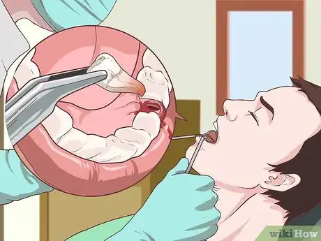 Imagen titulada Prepare for Tooth Extraction Step 10