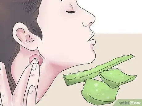Imagen titulada Treat an Infected Sebaceous Cyst Step 7