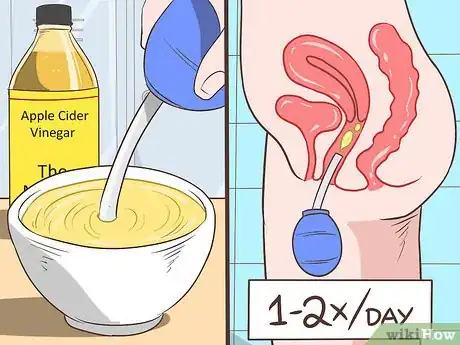 Imagen titulada Treat a Yeast Infection Step 16