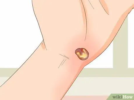 Imagen titulada Treat a Blood Blister Step 19