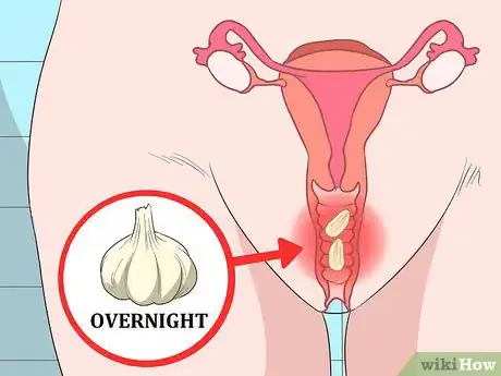 Imagen titulada Treat a Yeast Infection Step 18
