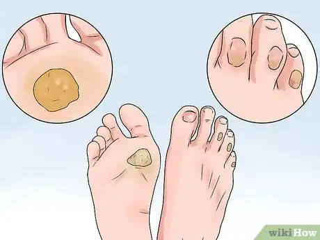 Imagen titulada Treat a Corn or Callus Step 1