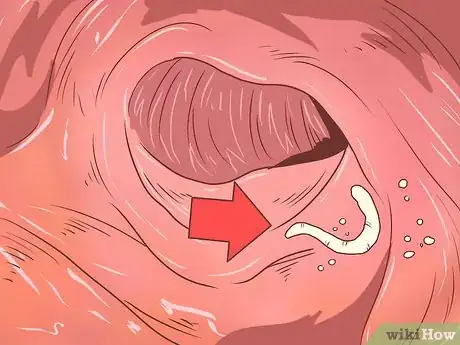 Imagen titulada Recognize and Prevent a Pinworm Infection Step 3