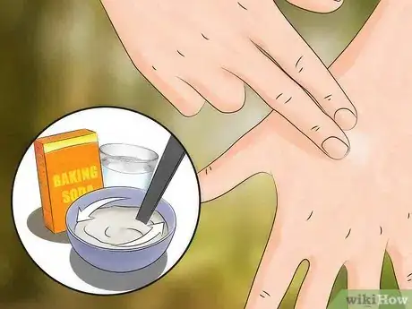 Imagen titulada Get Rid of Bug Bites Step 5