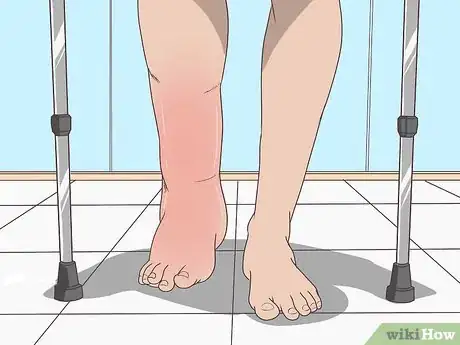 Imagen titulada Treat Swelling Step 1