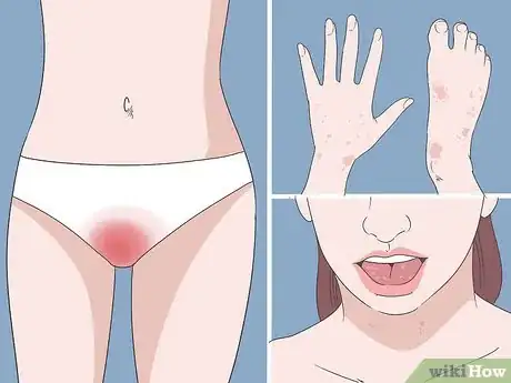 Imagen titulada Diagnose a Yeast Infection at Home Step 3