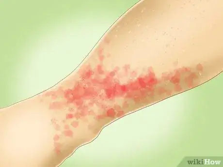 Imagen titulada Treat Pinpoint Petechiae Step 3