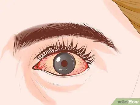 Imagen titulada Know if You Have Glaucoma Step 7