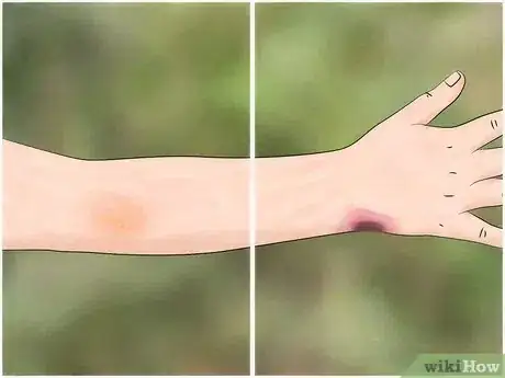 Imagen titulada Identify a Spider Bite Step 4