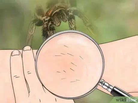 Imagen titulada Identify a Spider Bite Step 3