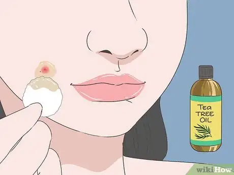Imagen titulada Get Rid of a Blind Pimple Step 1