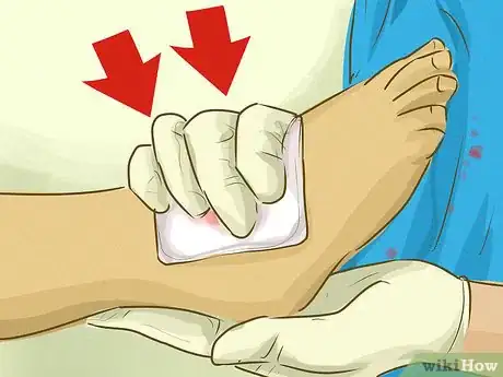 Imagen titulada Stop Bleeding Step 18