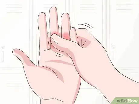 Imagen titulada Reduce Swollen Fingers Step 8