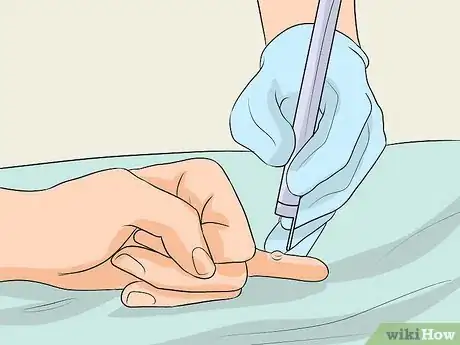 Imagen titulada Get Rid of Warts on Fingers Step 5