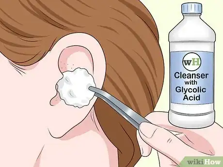 Imagen titulada Get Blackheads Out of Your Ear Step 1