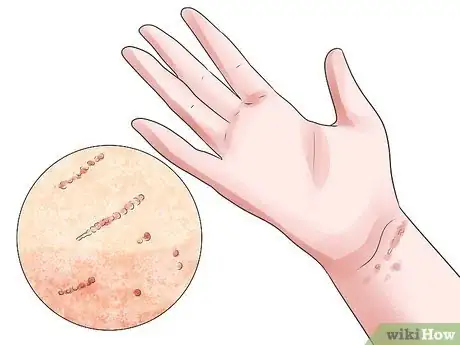 Imagen titulada Recognize Scabies Rash Step 3