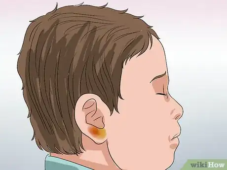 Imagen titulada Know if You Have Otitis Media Step 12