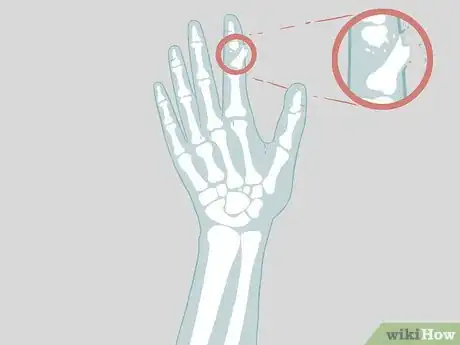 Imagen titulada Determine if a Finger Is Broken Step 17