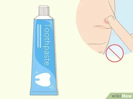 Imagen titulada Instantly Get Rid of a Pimple (Cotton Ball Popping Method) Step 10